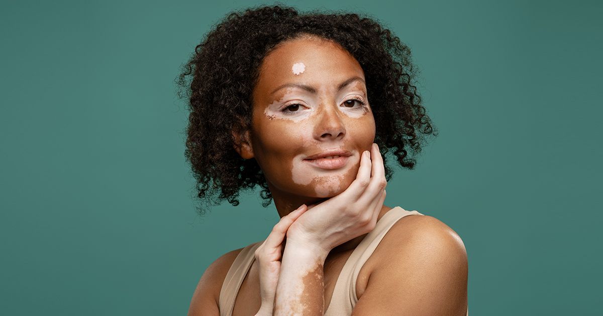 Comment pouvez-vous contribuer à gérer naturellement le vitiligo