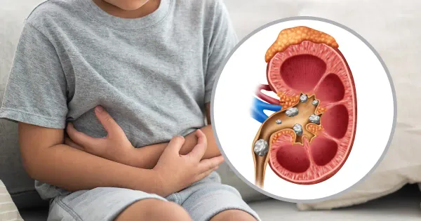Les calculs rénaux chez les enfants sont de plus en plus répandus : voici les raisons de cette tendance croissante et comment lutter contre ce phénomène