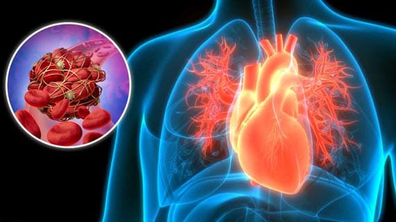 Les caillots sanguins peuvent être à l’origine de toutes les maladies cardiaques
