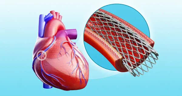 Les stents sont-ils une arnaque ?